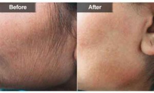 Laser-Hair-Removal___